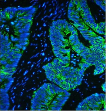 Immunofluorescent staining of FFPE human intestinal cancer with Keratin 8 antibody (green) and DAPI 