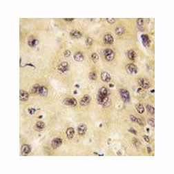 IHC analysis of FFPE human hepatocarcinoma tissue stained with PROX1 antibody