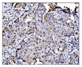 IHC staining of FFPE human breast cancer tissue with NDE1 antibody. HIER: boil tissue sections in pH