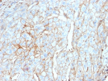 IHC testing of FFPE cervical carcinoma with PD-L1 antibody (clone PDL1/2746). HIER: boil tissue sect