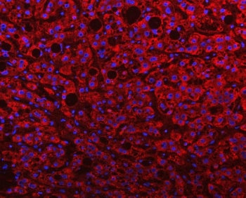 Immunofluorescent staining of FFPE human liver cancer with PGP antibody (red) and DAPI nuclear stain