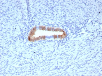IHC staining of FFPE human cervical carcinoma tissue with P16INK4a antibody (clone rCDKN2A/8062). HI