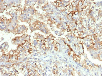 IHC staining of FFPE human kidney carcinoma tissue with CD276 antibody (clone B7H3/4312) at 2ug/ml. 