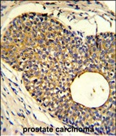 IHC staining of FFPE human prostate carcinoma tissue with Phorbolin 1 antibody. HIER: steam section 