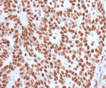 IHC staining of FFPE human breast carcinoma with Estrogen Receptor alpha antibody (clone NR3Ga-4). H