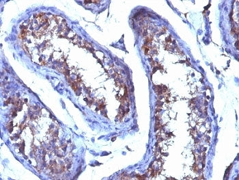 IHC testing of FFPE human testicular carcinoma with Testosterone antibody (clone 4E1G2). Required HI