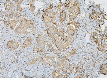 IHC staining of FFPE human breast cancer with IQGAP1 antibody at 1ug/ml. HIER: boil tissue sections 
