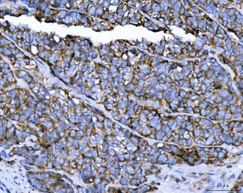 IHC staining of FFPE human prostate cancer tissue with TRPM4 antibody. HIER: boil tissue sections in