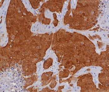 IHC staining of FFPE human bladder carcinoma tissue with P16INK4a antibody (clone CDKN2A/8196R). HIE
