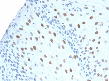 IHC testing of human urothelial carcinoma with recombinant CDNK1A antibody (CIP1/2275R). Required HI