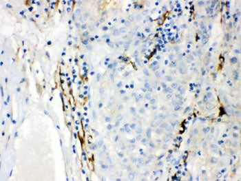 IHC testing of FFPE human liver cancer tissue with CYP1B1 antibody. HIER: Boil the paraffin sections