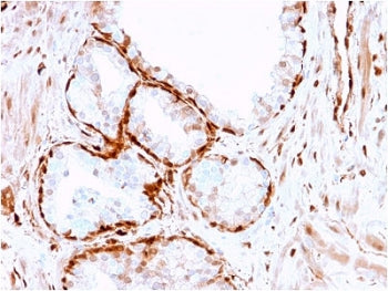 IHC testing of FFPE human prostate cancer with Aldose reductase antibody (clone CPTC-AKR1B1-3). Requ