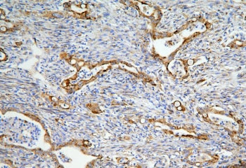 IHC staining of FFPE human rectal cancer with LONP1 antibody. HIER: boil tissue sections in pH6, 10m