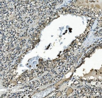 IHC staining of FFPE human renal clear cell carcinoma with MAP2K2 antibody. HIER: boil tissue sectio