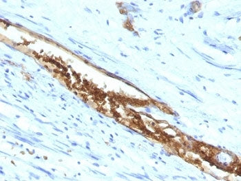 IHC: Formalin-fixed, paraffin-embedded human colon carcinoma stained with Blood Group Antigen A anti