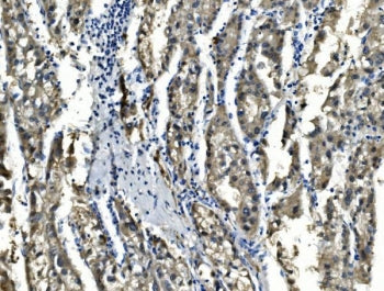 IHC staining of FFPE human liver cancer with SORD antibody. HIER: boil tissue sections in pH8 EDTA f