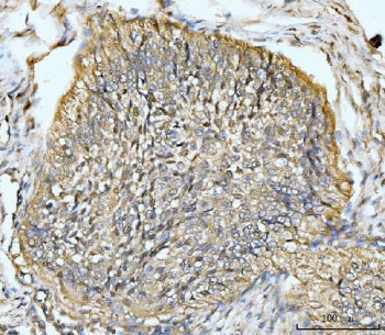 IHC staining of FFPE human lung cancer tissue with HMGCS1 antibody. HIER: boil tissue sections in pH