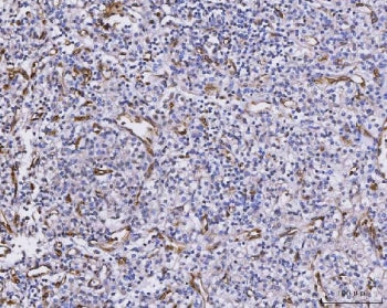 IHC staining of FFPE human glioma tissue with CXCL1 antibody. HIER: boil tissue sections in pH8 EDTA