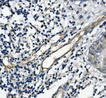 IHC staining of FFPE human breast cancer with PECAM1 antibody. HIER: boil tissue sections in pH8 EDT