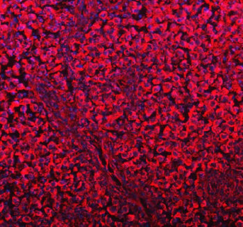 Immunofluorescent staining of FFPE human testis cancer tissue with DYNLT1 antibody (red) and DAPI nu