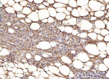 IHC staining of FFPE human smooth muscle fatty carcinoma of the left kidney tissue with NDUFB8 antib