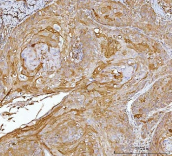 IHC staining of FFPE human laryngeal squamous cell carcinoma tissue with CRABP2 antibody. HIER: boil