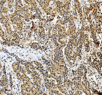 IHC staining of FFPE human liver cancer tissue with PSMA5 antibody, HRP-secondary and DAB substrate.