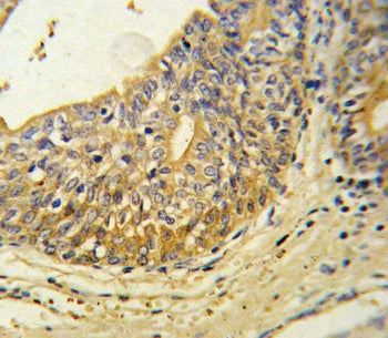 IHC testing of FFPE human prostate carcinoma tissue with Endothelin B Receptor antibody. HIER: steam