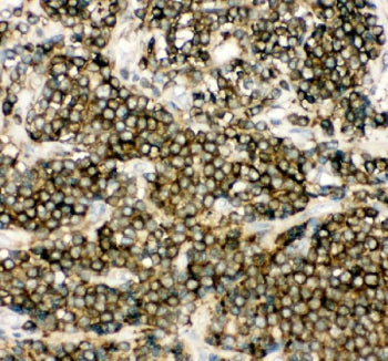 IHC staining of FFPE human lung cancer tissue with NFKB1 antibody. HIER: boil tissue sections in pH8