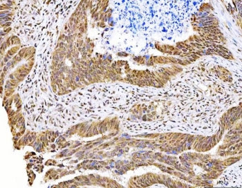 IHC staining of FFPE human bladder urothelial carcinoma tissue with MAGED4 antibody. HIER: boil tiss