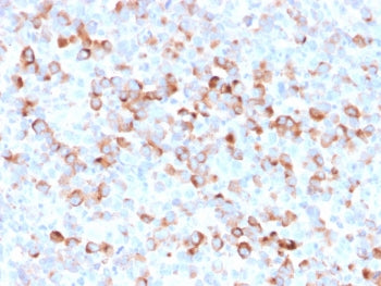 IHC staining of FFPE human Melanoma with recombinant Tyrosinase antibody (clone rOCA1/812). Required
