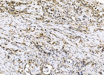 IHC staining of FFPE human stomach cancer tissue with Sigma1-receptor antibody. HIER: boil tissue se