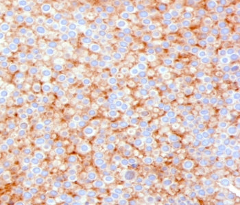 IHC testing of FFPE human urothelial carcinoma with SERBP1 antibody (clone PARB1-1). Required HIER: 