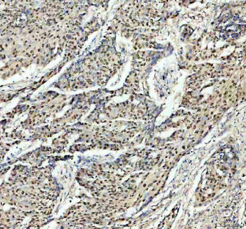 Immunohistochemical staining of PSME3 using anti-PSME3 antibody. PSME3 was detected in a paraffin-em