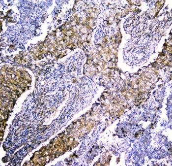 IHC staining of FFPE human lung cancer with LRTOMT antibody. HIER: boil tissue sections in pH6, 10mM