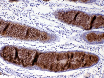 IHC testing of FFPE human rectal cancer tissue with Mucin-2 antibody at 1ug/ml. Required HIER: steam