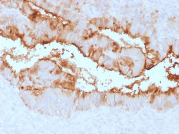 IHC testing of FFPE human endometrial carcinoma with recombinant MUC16 antibody (clone OCA125/2349R)