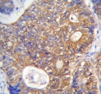 IHC testing of FFPE human colon carcinoma tissue with ADE2 antibody. HIER: steam section in pH6 citr