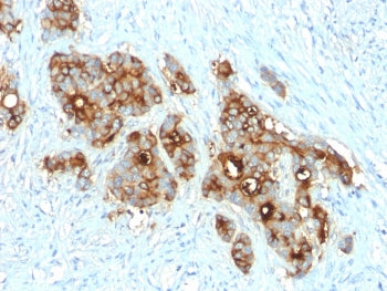 IHC testing of FFPE human colon carcinoma with CD66 antibody (clone C66/2055R). Required HIER: boil 