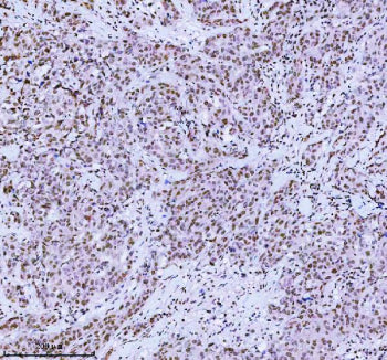 Immunohistochemical staining of MED4 using anti-MED4 antibody. MED4 was detected in a paraffin-embed