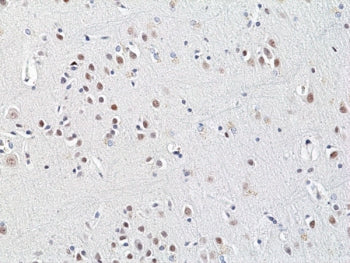IHC staining of FFPE human brain cancer tissue with recombinant HDCAC3 antibody at 1:200.