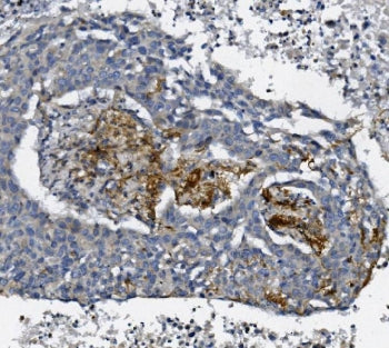 IHC staining of FFPE human lung cancer with AFAP1 antibody. HIER: boil tissue sections in pH8 EDTA f