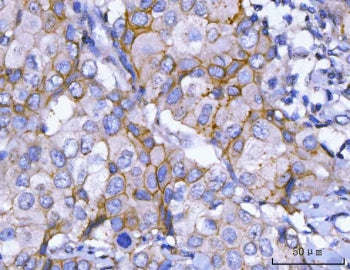 IHC staining of FFPE human breast cancer tissue with HER2 antibody. HIER: boil tissue sections in pH