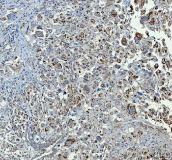 IHC staining of FFPE human lung adenocarcinoma tissue with CHGA antibody. HIER: boil tissue sections in pH8 EDTA for 20 min and allow to cool before testing.