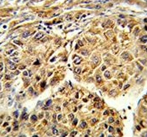 IHC testing of FFPE human hepatocellular carcinoma tissue with Cytochrome p450 2C19 antibody. HIER: 