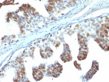 IHC testing of human prostate carcinoma with PTEN antibody (clone PTEN/2110). Required HIER: boil ti