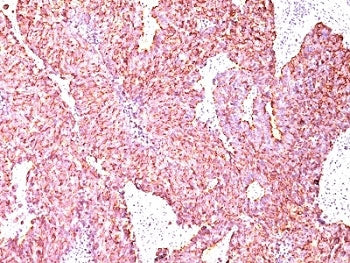 IHC: Formalin-fixed, paraffin-embedded human small cell lung carcinoma stained with Chromogranin A a
