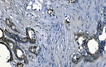 IHC staining of FFPE human rectal cancer with PCBP2 antibody. HIER: boil tissue sections in pH8 EDTA