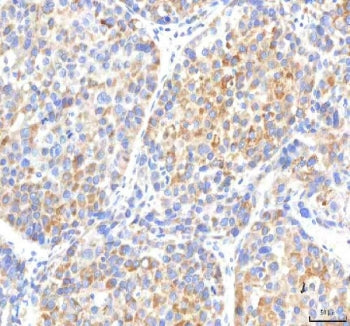 IHC staining of FFPE human liver cancer tissue with IPO8 antibody. HIER: boil tissue sections in pH8