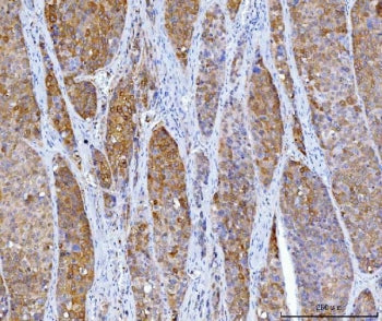 IHC staining of FFPE human liver cancer tissue with Homogentisate 1,2-dioxygenase antibody. HIER: bo